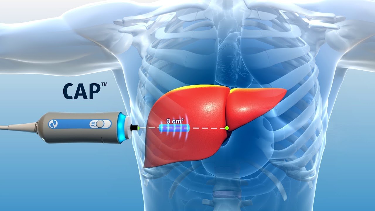 Advanced Liver FibroScan